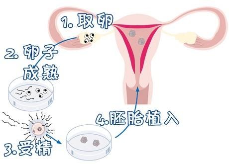 染色体易位